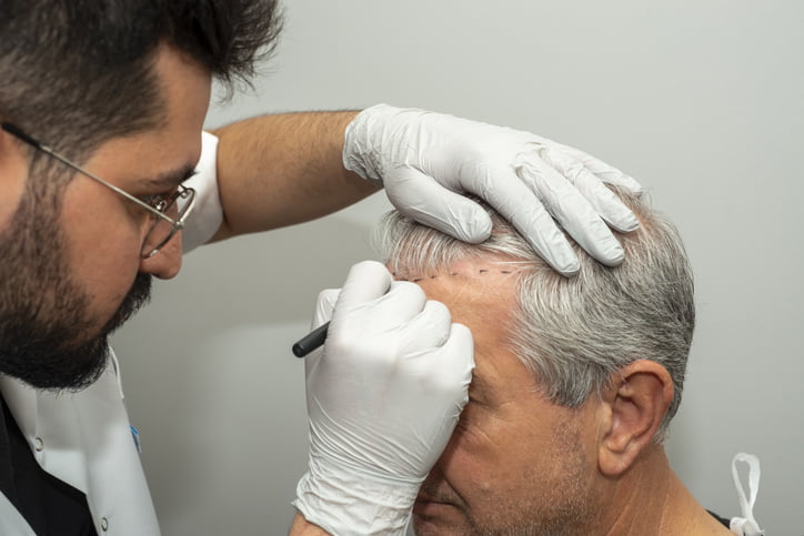 What is the combined hair restoration technique involving PRP & FUE?