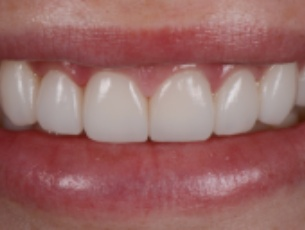 Invisalign wimbledon