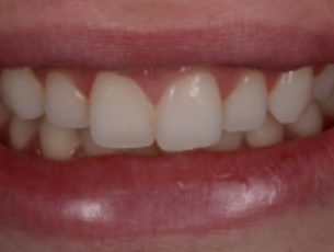 invisalign wimbledon